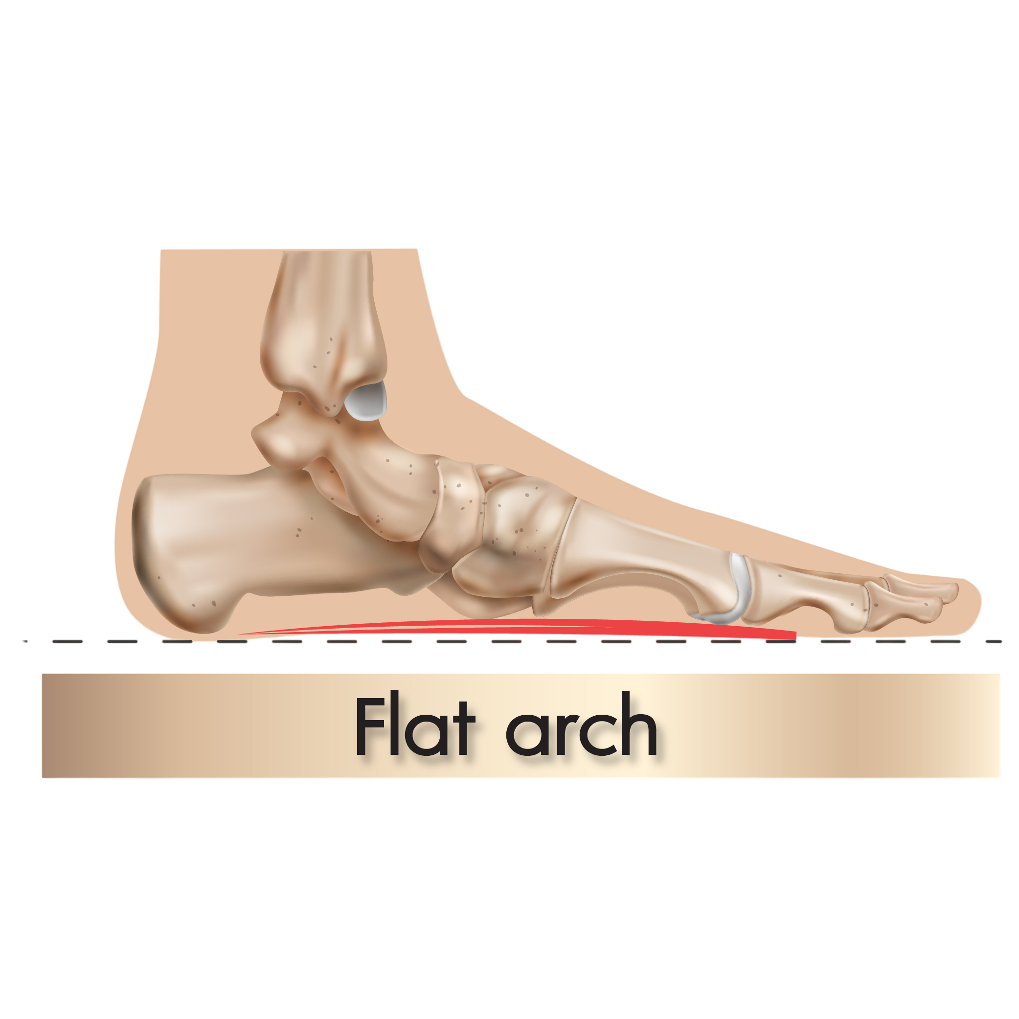 Flat Arch