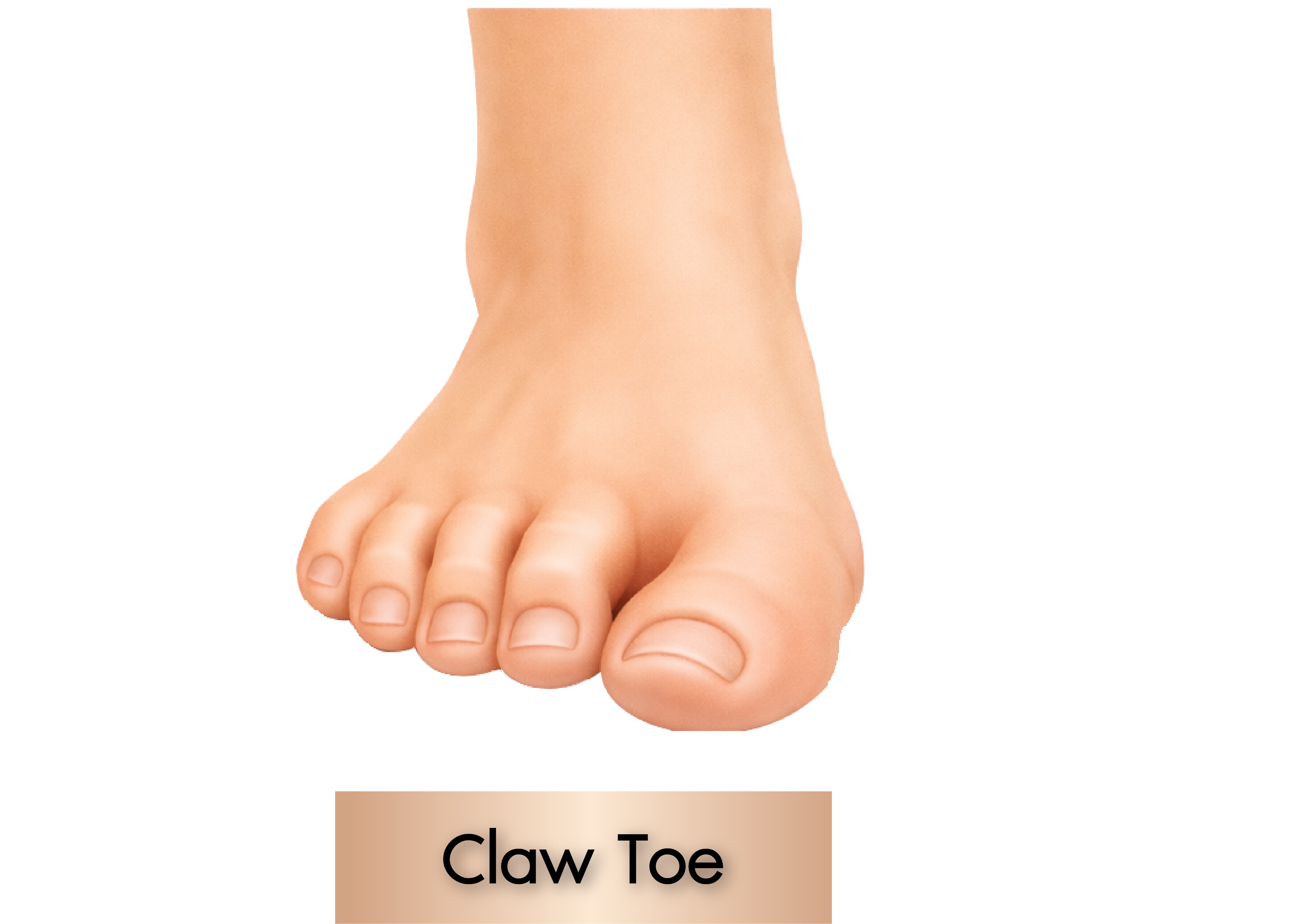 Claw Toe